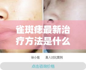 雀斑痣最新治疗方法是什么：雀斑样痣百科 